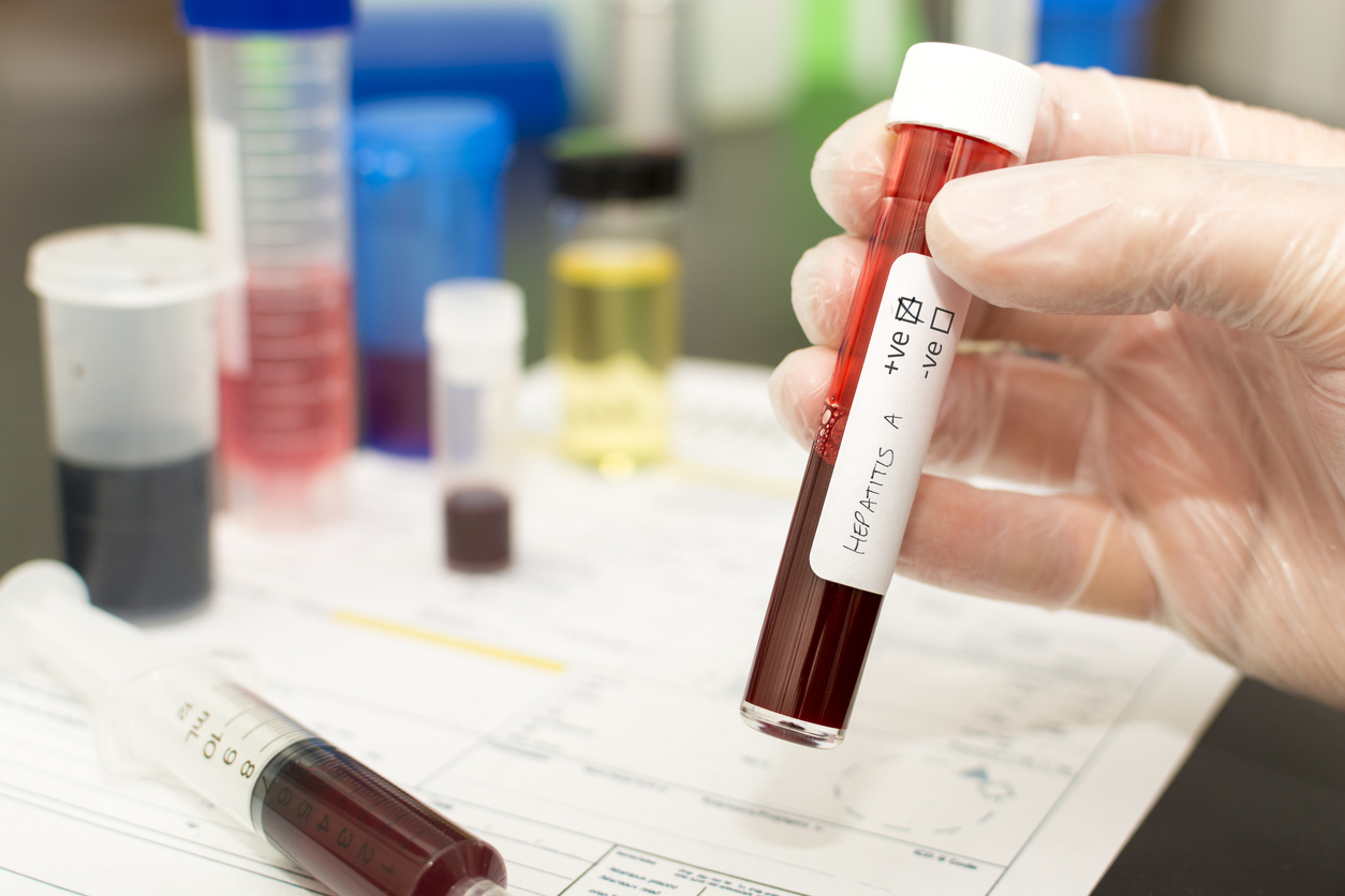 Hepatitis A – blood in a test tube